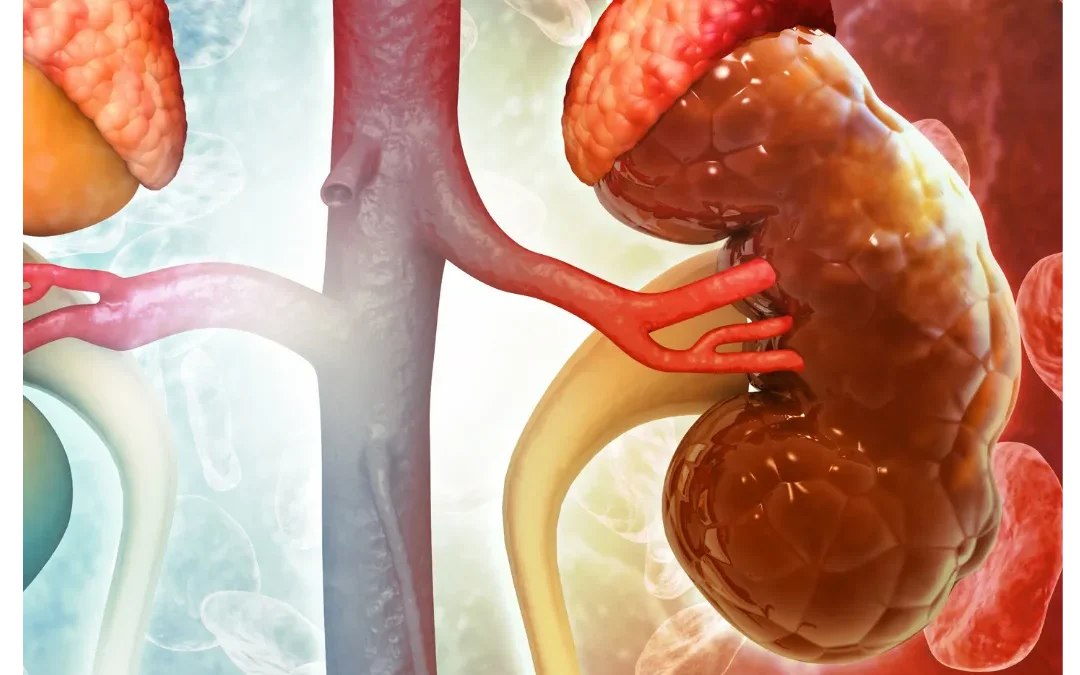 The Link Between Peripheral Arterial Disease and Chronic Kidney Disease