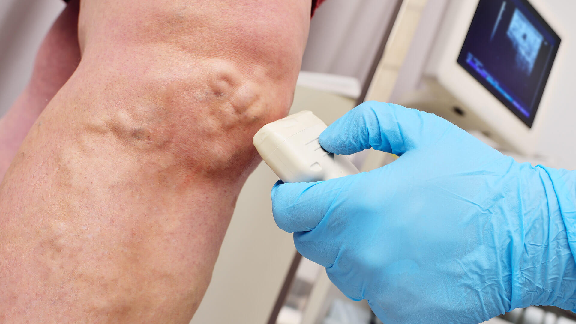 Duplex Vascular Ultrasound Image Duplex Vascular Ultrasound Image