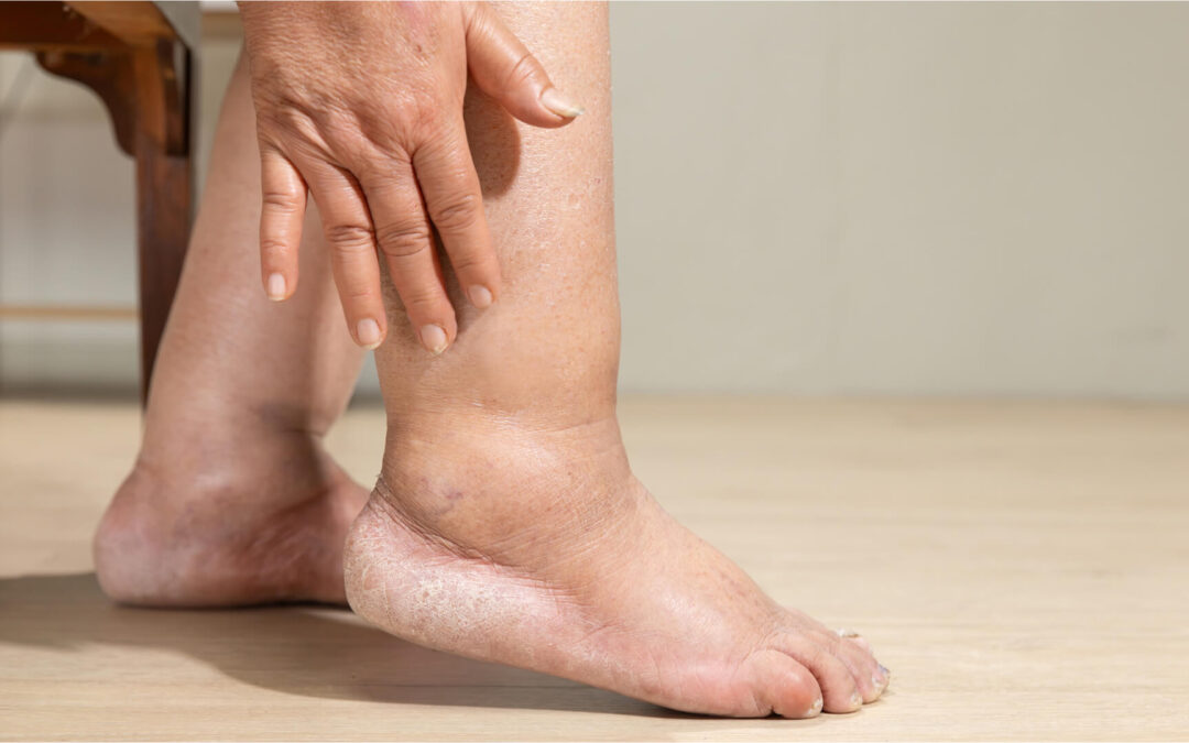 Peripheral Arterial Disease Treatment in New Jersey