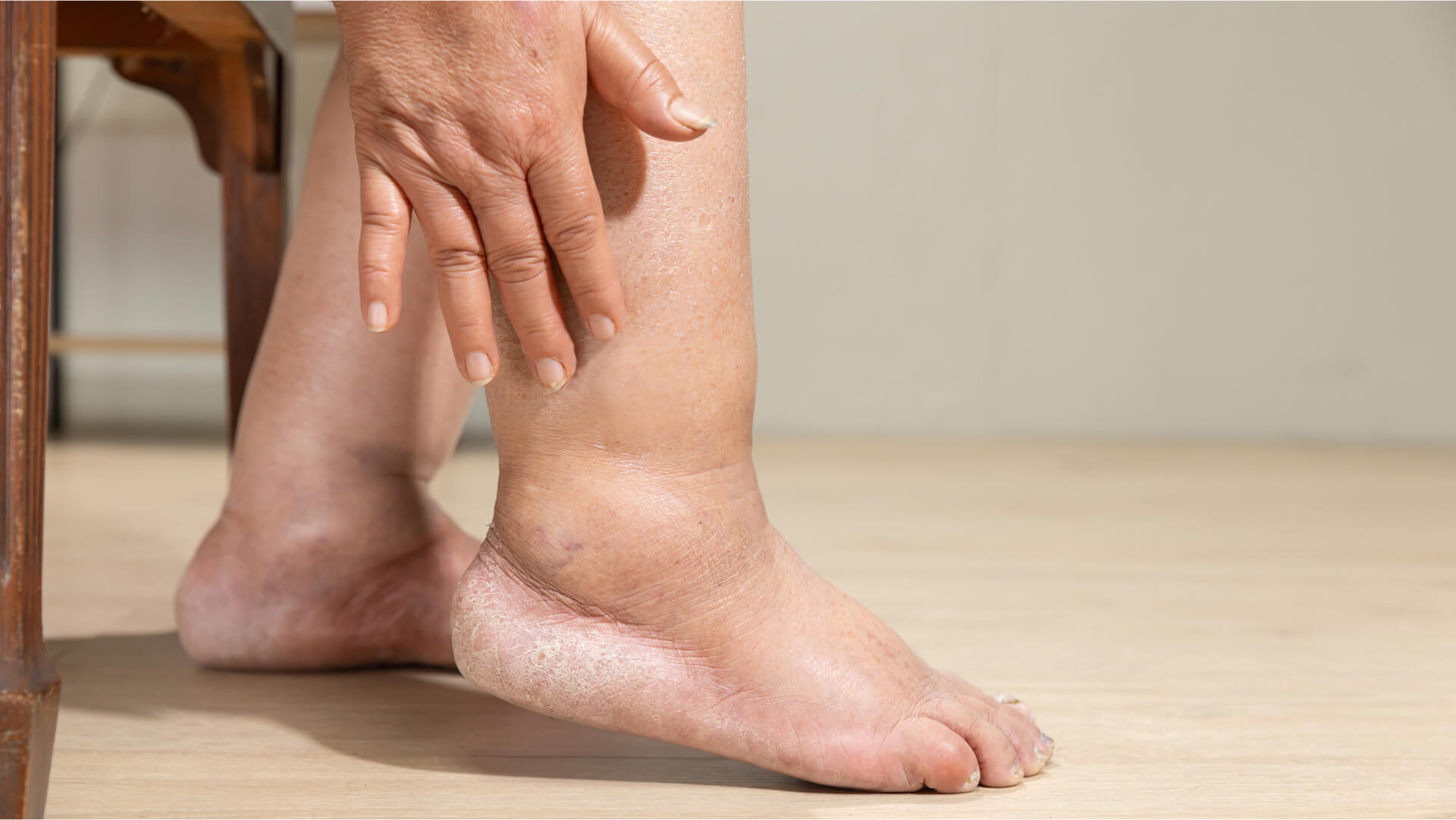 Peripheral Arterial Disease Image Peripheral Arterial Disease