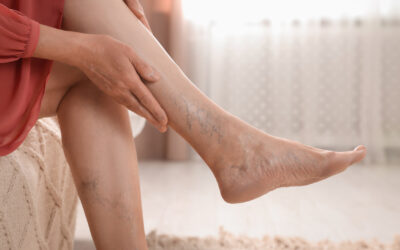 Everything You Need to Know About Venous Disease