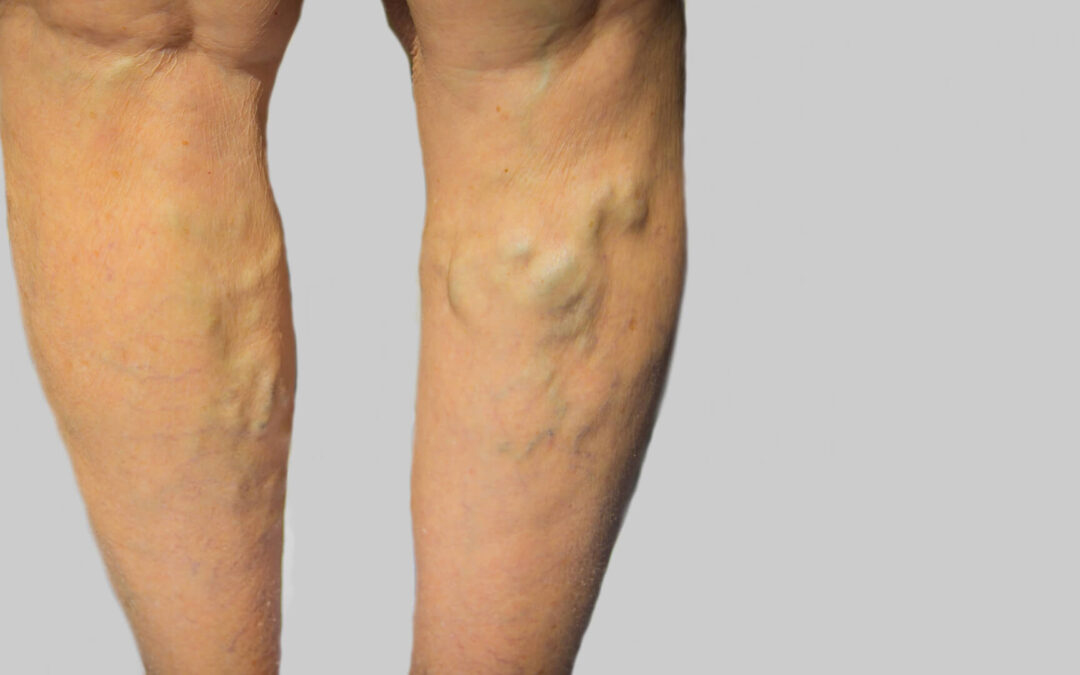 Vein Disease Treatment in New Jersey