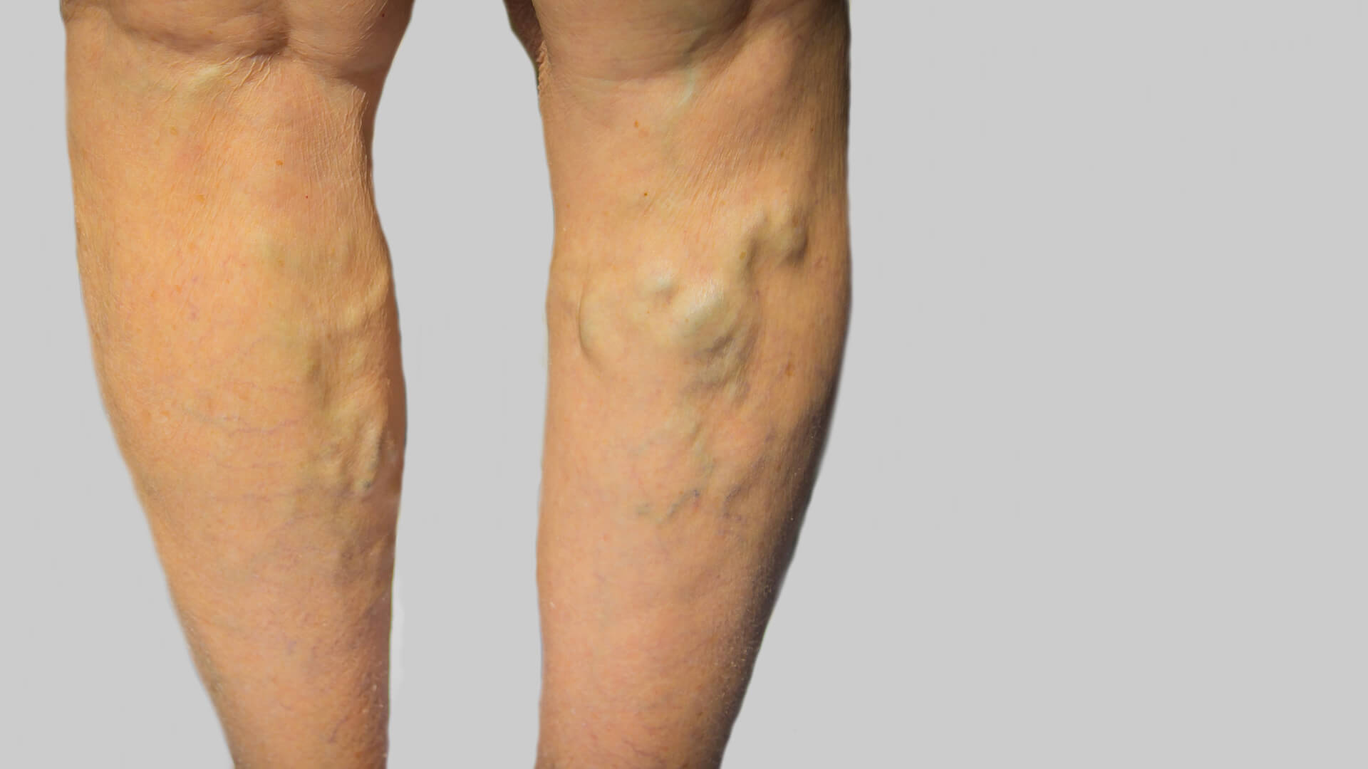 Venous Disease Legs Image Venous Disease Legs Image