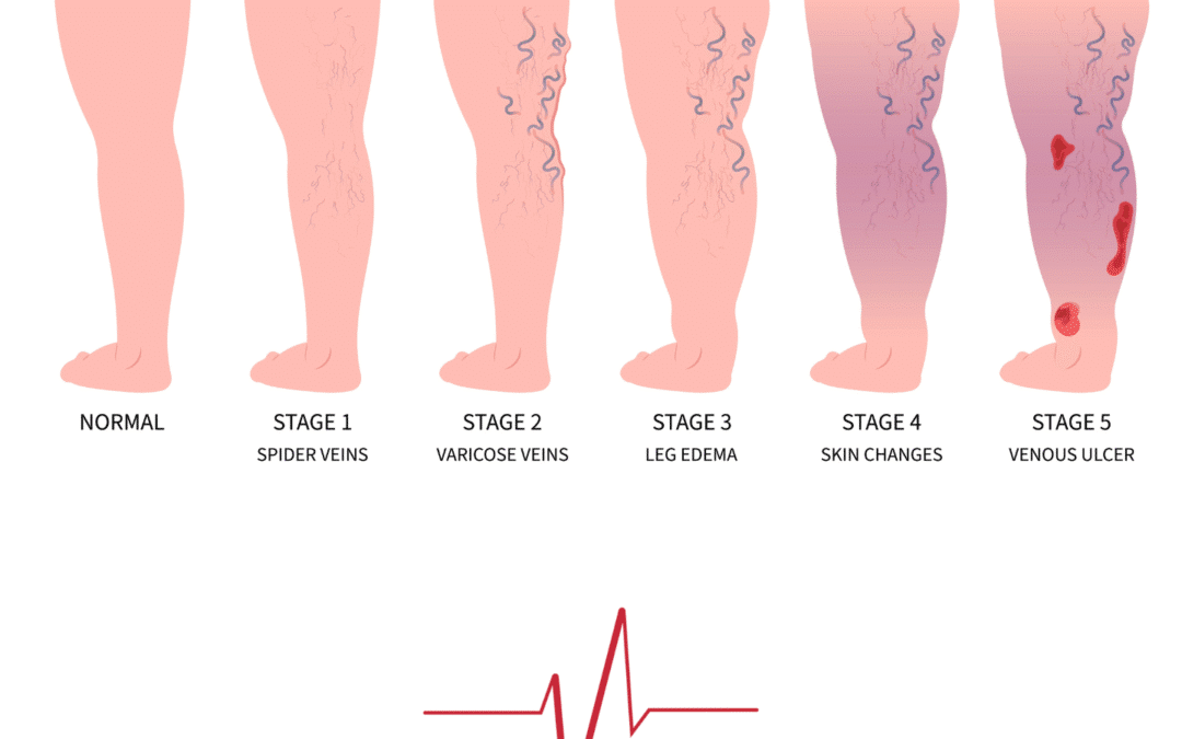 What is CVI?
